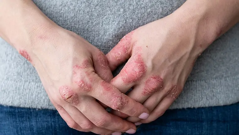 Sedef Hastalığı İçin Hangi Oranda Engelli Raporu Verilir?