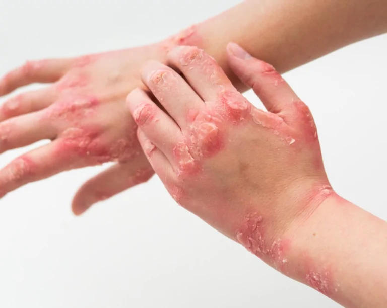 Egzama İçin Hangi Oranda Engelli Raporu Verilir?