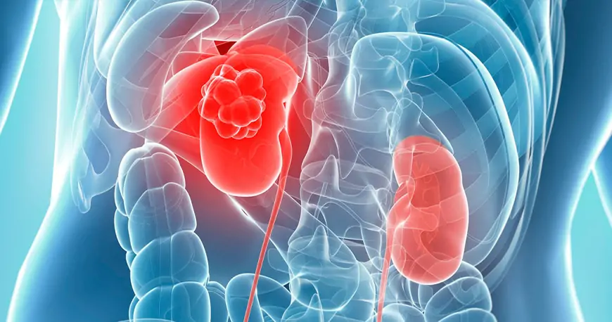Wilms Tümörü Nedir?
