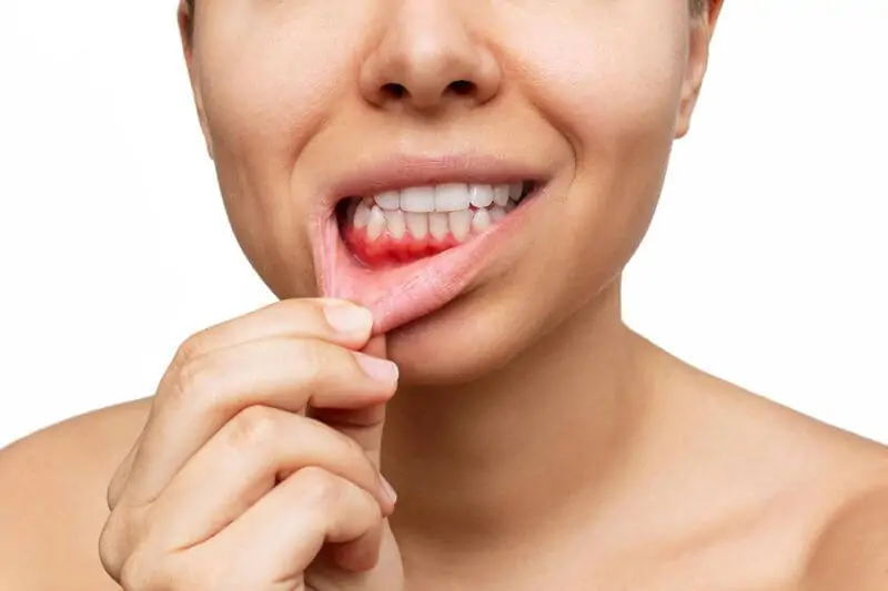Ağız Boşluğu (Oral Kavite) Kanseri İçin Hangi Oranda Engelli Raporu Verilir?