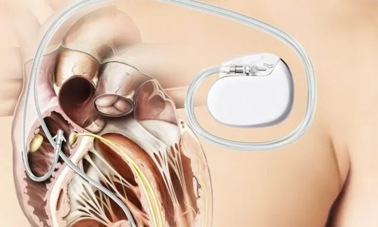 Kalp Pili İçin Hangi Oranda Engelli Raporu Verilir?