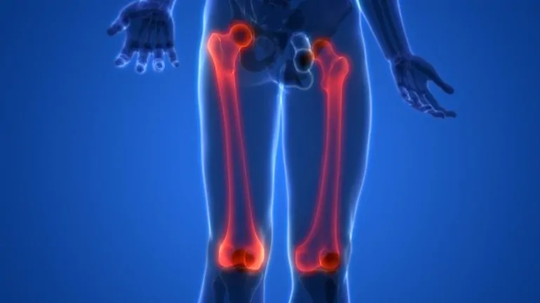 Femur Kırığı İçin Hangi Oranda Engelli Raporu Verilir?