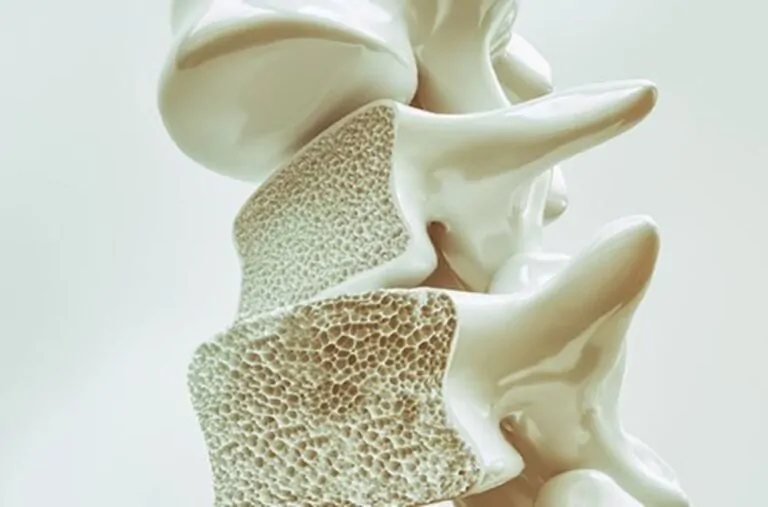 Kemik Erimesi (Osteoporoz) İçin Hangi Oranda Engelli Raporu Verilir?