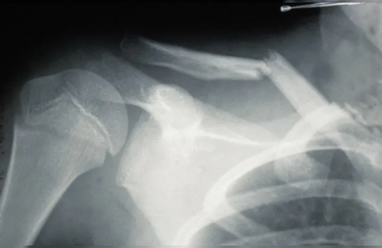 Perilunat Çıkık ve Kırıklı Çıkıklar İçin Hangi Oranda Engelli Raporu Verilir?