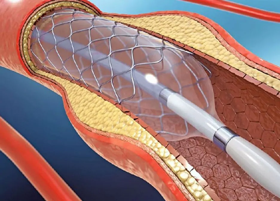 Stent İçin Hangi Oranda Engelli Raporu Verilir?