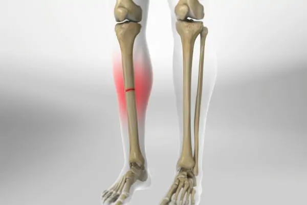 Tibia Kırığı İçin Hangi Oranda Engelli Raporu Verilir?