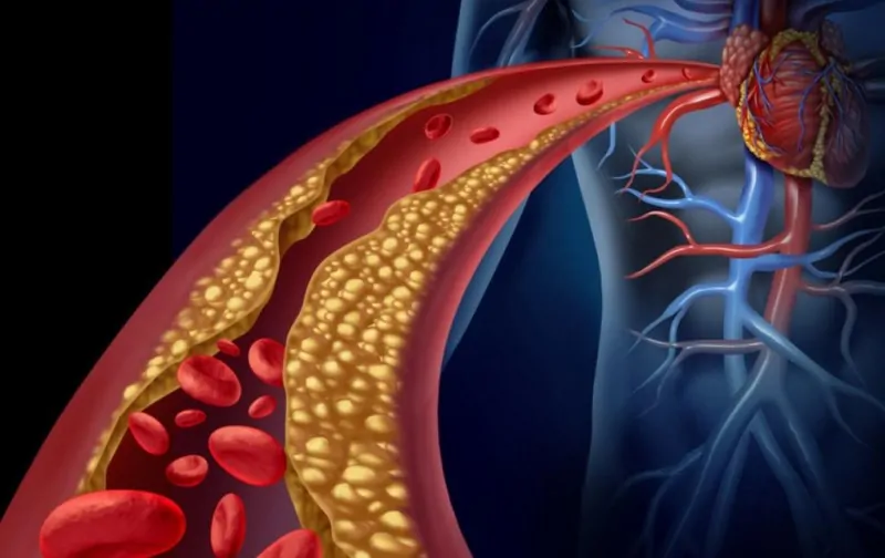 Hiperkolesterolemi İçin Hangi Oranda Engelli Raporu Verilir?