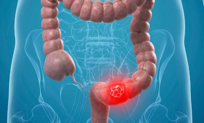 Kolon Kanseri İçin Hangi Oranda Engelli Raporu Verilir?